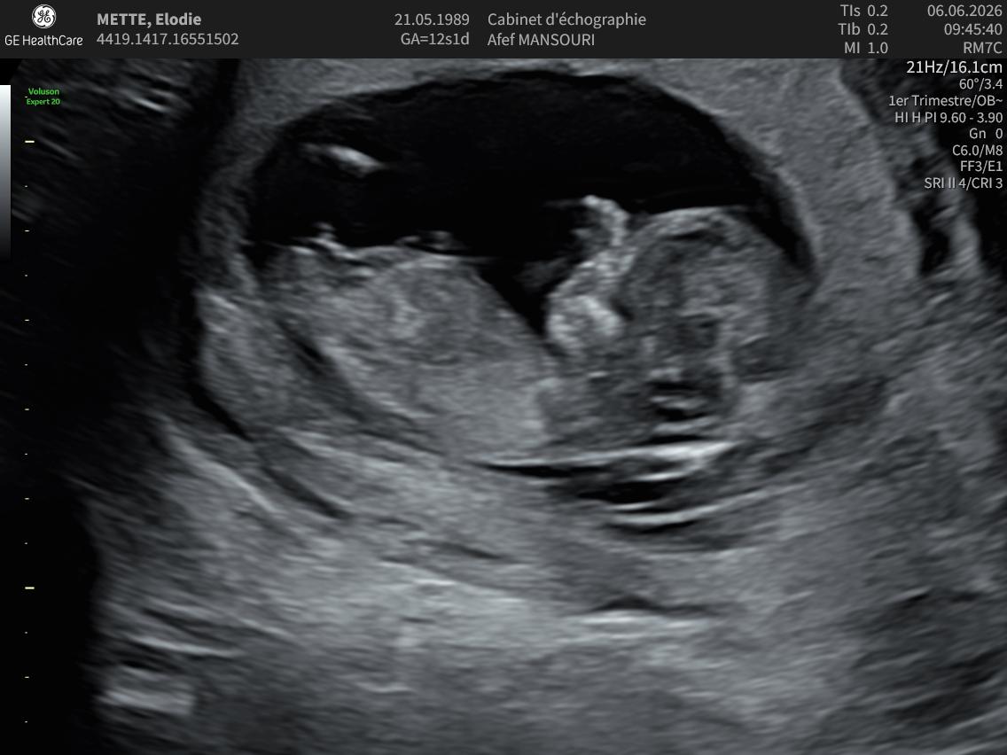 Échographie du bébé